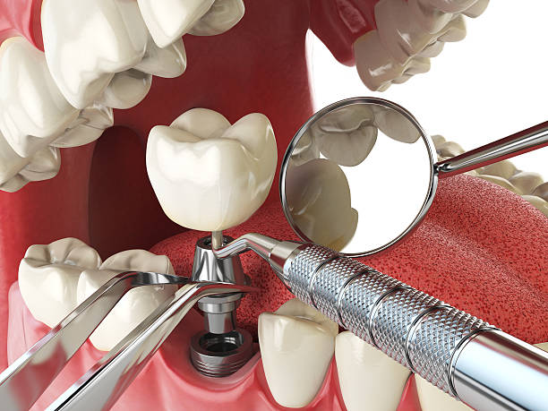 Best Emergency Broken Tooth Repair in Hiram, GA